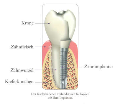 MKG Praxis Lahsntein Zahnimplantat