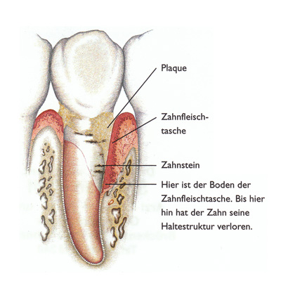 MKG Praxis Lahnstein Koblenz. Parodontitis-Therapie: Verlorener Zahnhalt. Gebildeter Zahnstein und geschädigte Zahnfleischtasche.