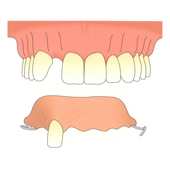 MKG Praxis Lahnstein Koblenz. Implantat-Therapie Herausnehmbare Teilprotese.